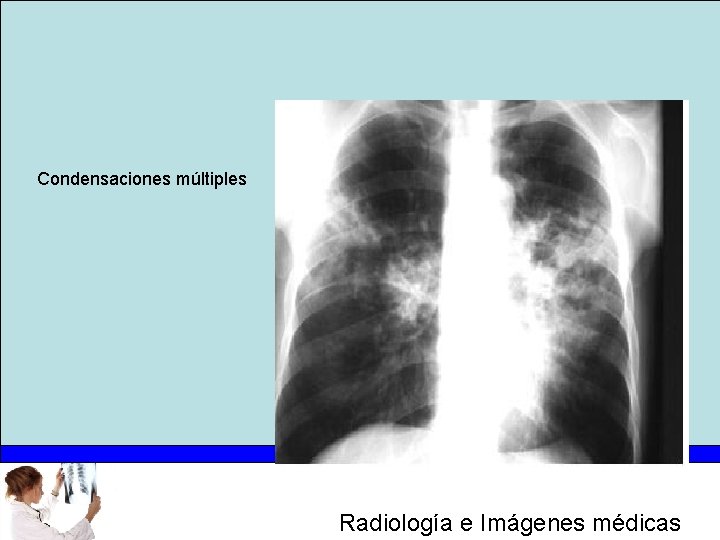 Condensaciones múltiples Radiología e Imágenes médicas 
