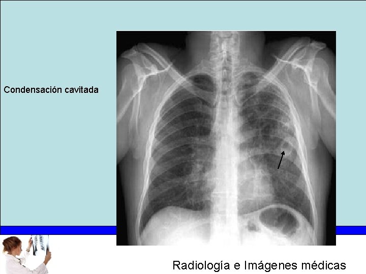 Condensación cavitada Radiología e Imágenes médicas 