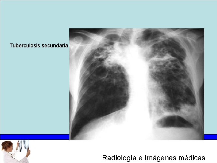 Tuberculosis secundaria Radiología e Imágenes médicas 