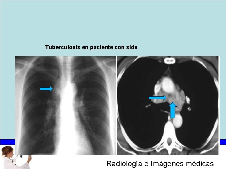 Tuberculosis en paciente con sida Radiología e Imágenes médicas 