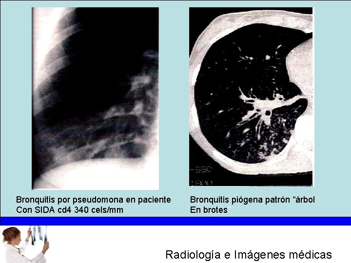Bronquitis por pseudomona en paciente Con SIDA cd 4 340 cels/mm Bronquitis piógena patrón