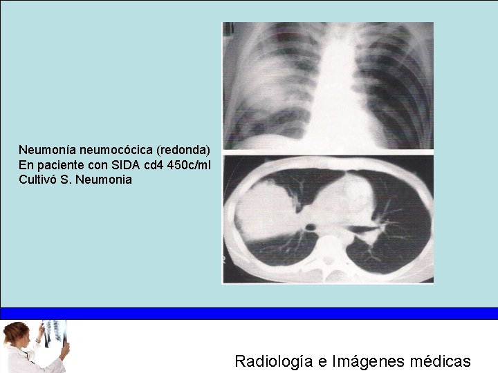 Neumonía neumocócica (redonda) En paciente con SIDA cd 4 450 c/ml Cultivó S. Neumonia