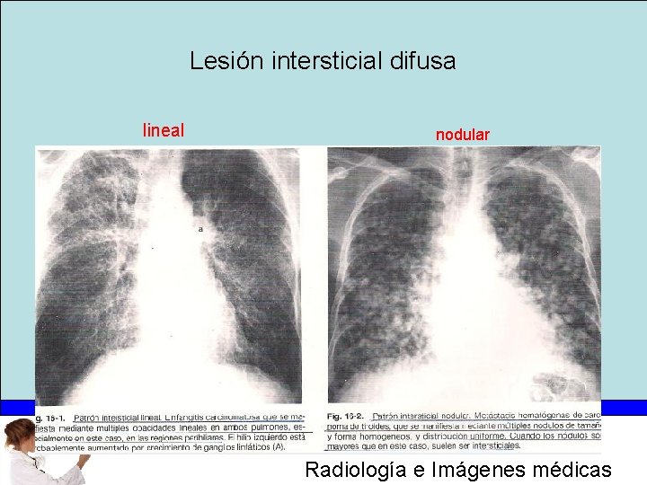 Lesión intersticial difusa lineal nodular Radiología e Imágenes médicas 