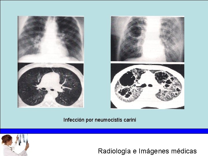 Infección por neumocistis carini Radiología e Imágenes médicas 