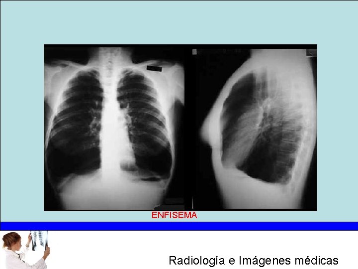 ENFISEMA Radiología e Imágenes médicas 