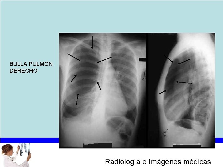 BULLA PULMON DERECHO Radiología e Imágenes médicas 