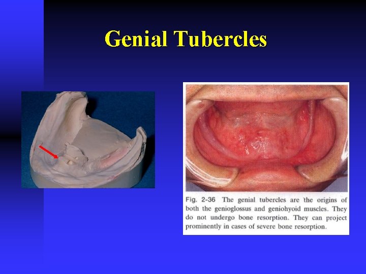 Genial Tubercles 
