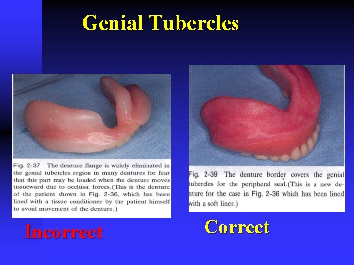 Genial Tubercles Incorrect Correct 