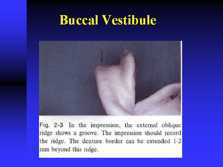 Buccal Vestibule 