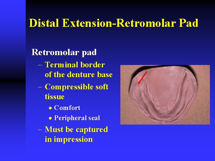 Distal Extension-Retromolar Pad Retromolar pad - Terminal border of the denture base - Compressible