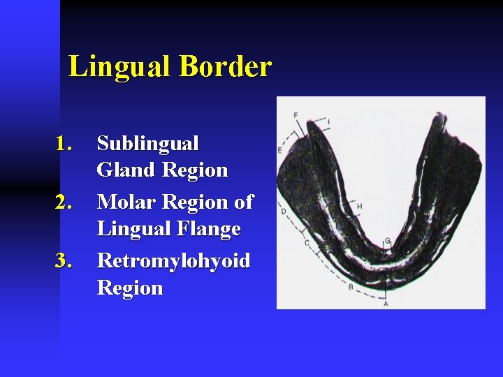 Lingual Border 1. 2. 3. Sublingual Gland Region Molar Region of Lingual Flange Retromylohyoid