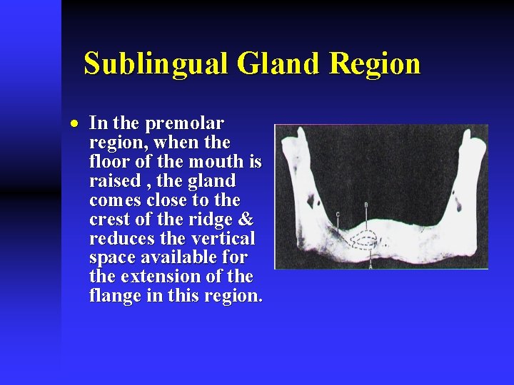 Sublingual Gland Region · In the premolar region, when the floor of the mouth