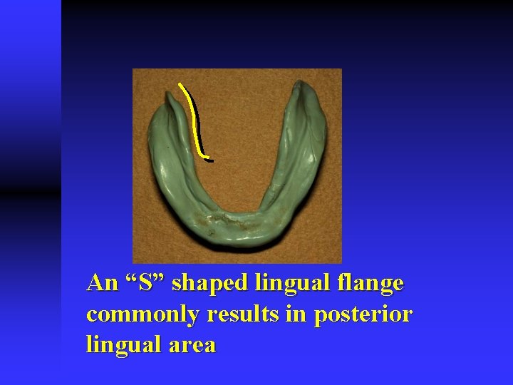 An “S” shaped lingual flange commonly results in posterior lingual area 