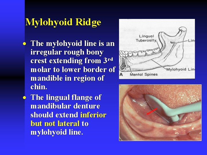 Mylohyoid Ridge · The mylohyoid line is an irregular rough bony crest extending from