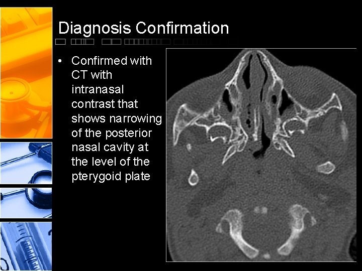 Diagnosis Confirmation • Confirmed with CT with intranasal contrast that shows narrowing of the