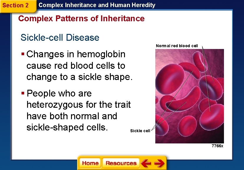 Section 2 Complex Inheritance and Human Heredity Complex Patterns of Inheritance Sickle-cell Disease Normal