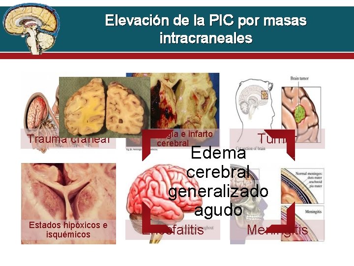 Elevación de la PIC por masas intracraneales Trauma craneal Hemorragia e infarto cerebral Tumor