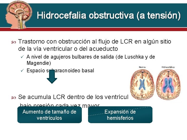 Hidrocefalia obstructiva (a tensión) Trastorno con obstrucción al flujo de LCR en algún sitio