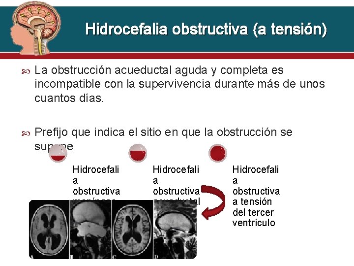 Hidrocefalia obstructiva (a tensión) La obstrucción acueductal aguda y completa es incompatible con la