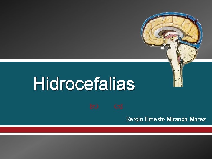 Hidrocefalias Sergio Ernesto Miranda Marez. 