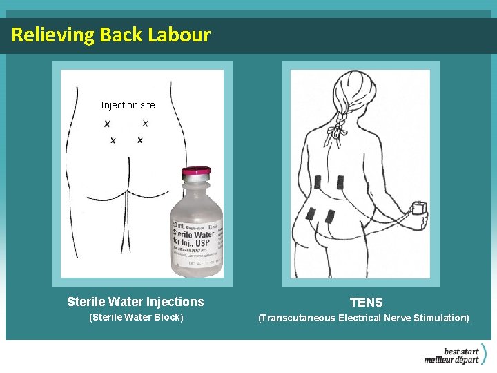 Relieving Back Labour Injection site Sterile Water Injections TENS (Sterile Water Block) (Transcutaneous Electrical
