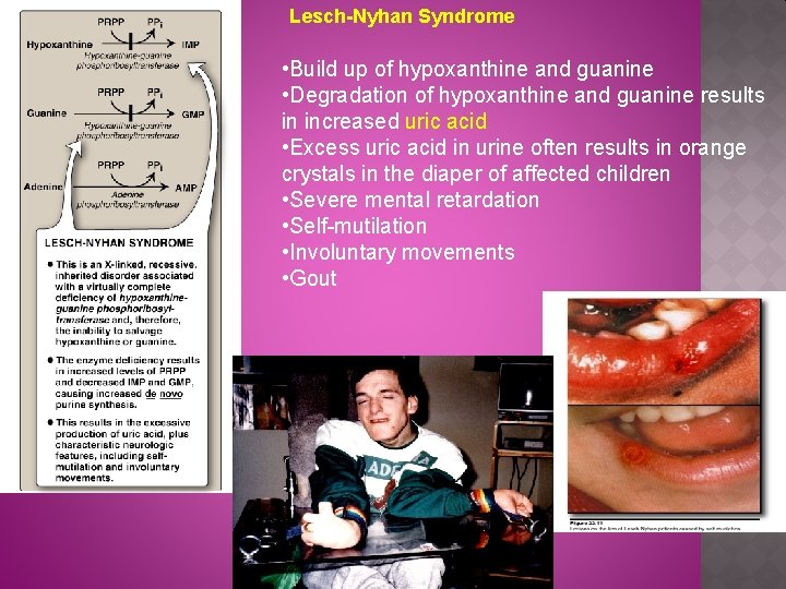Lesch-Nyhan Syndrome • Build up of hypoxanthine and guanine • Degradation of hypoxanthine and