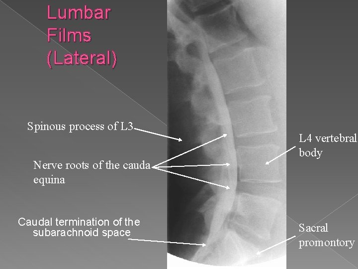 Lumbar Films (Lateral) Spinous process of L 3 Nerve roots of the cauda equina