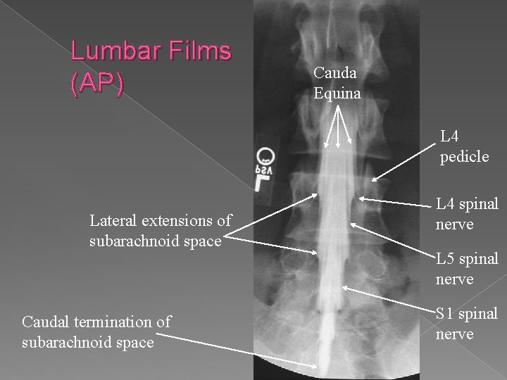 Lumbar Films (AP) � Cauda sd Equina L 4 pedicle Lateral extensions of subarachnoid
