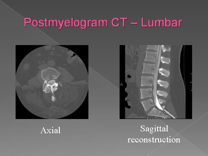 Postmyelogram CT – Lumbar Axial Sagittal reconstruction 