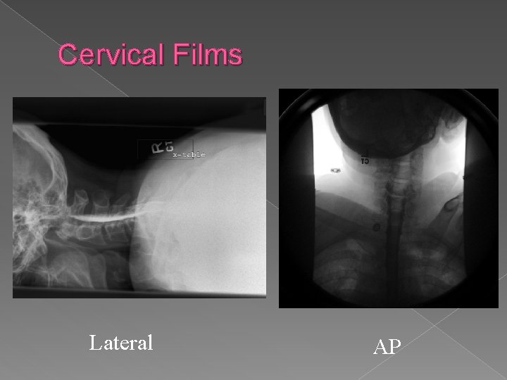Cervical Films Lateral AP 
