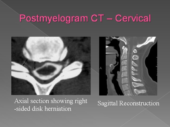 Postmyelogram CT – Cervical Axial section showing right -sided disk herniation Sagittal Reconstruction 