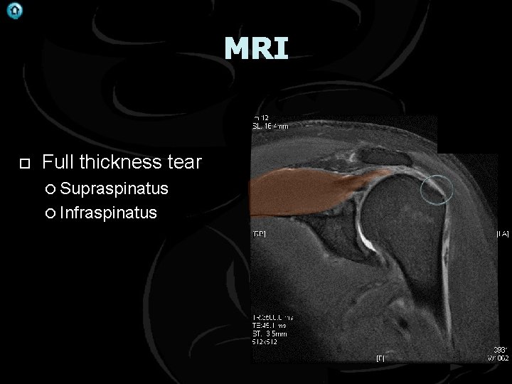. MRI Full thickness tear Supraspinatus Infraspinatus 