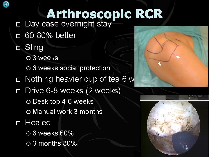 . Arthroscopic RCR Day case overnight stay 60 -80% better Sling 3 weeks 6