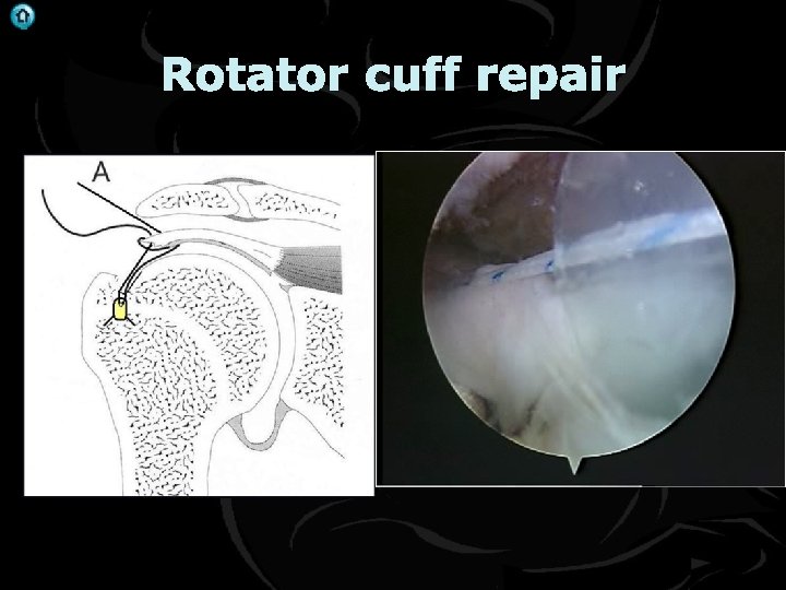 . Rotator cuff repair 