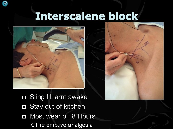 . Interscalene block Sling till arm awake Stay out of kitchen Most wear off