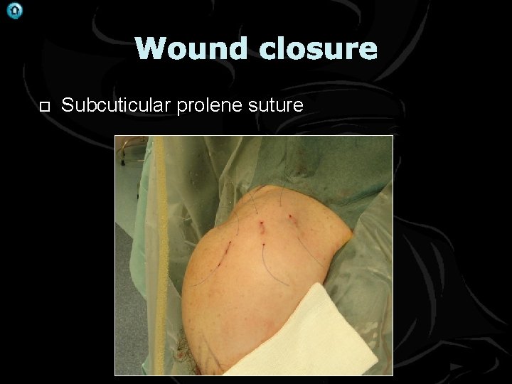 . Wound closure Subcuticular prolene suture 