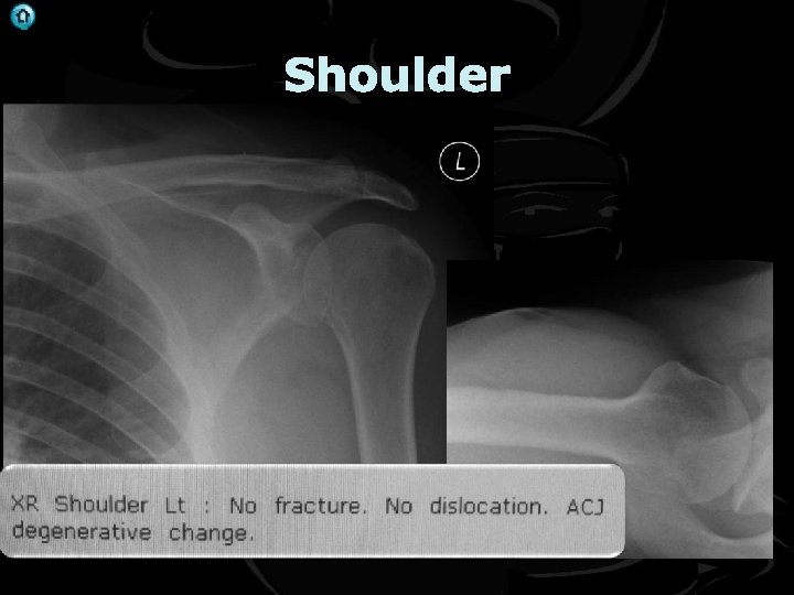 . Shoulder 