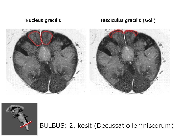 Nucleus gracilis Fasciculus gracilis (Goll) BULBUS: 2. kesit (Decussatio lemniscorum) 