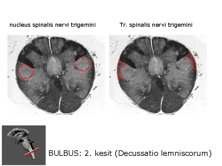 nucleus spinalis nervi trigemini Tr. spinalis nervi trigemini BULBUS: 2. kesit (Decussatio lemniscorum) 