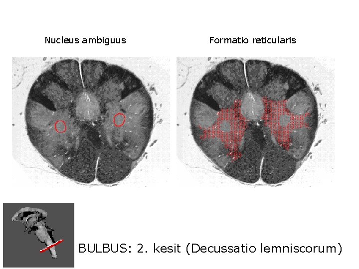 Nucleus ambiguus Formatio reticularis BULBUS: 2. kesit (Decussatio lemniscorum) 