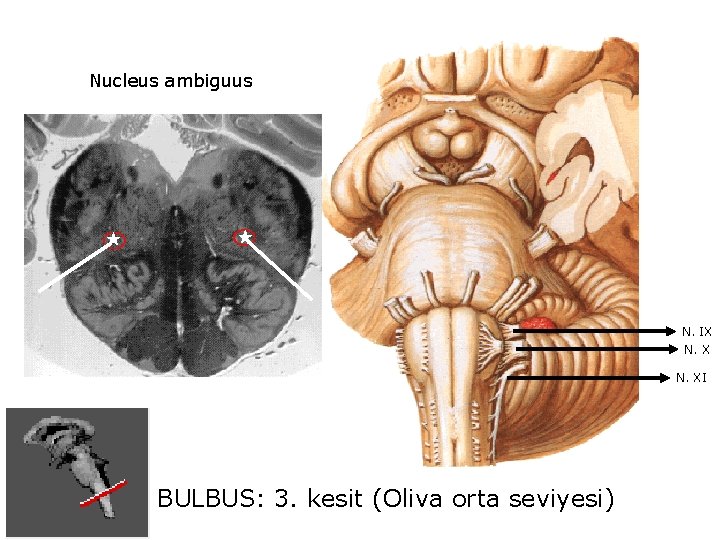 Nucleus ambiguus N. IX N. XI BULBUS: 3. kesit (Oliva orta seviyesi) 