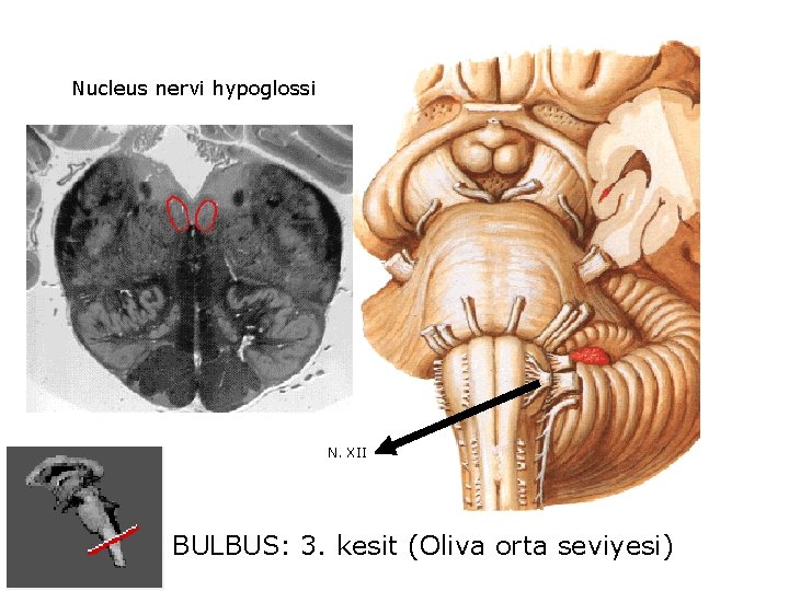 Nucleus nervi hypoglossi N. XII BULBUS: 3. kesit (Oliva orta seviyesi) 