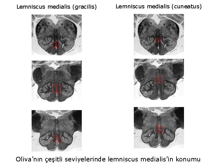 Lemniscus medialis (gracilis) Lemniscus medialis (cuneatus) Oliva’nın çeşitli seviyelerinde lemniscus medialis’in konumu 