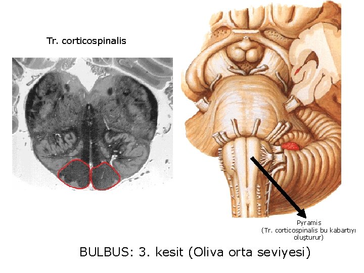 Tr. corticospinalis Pyramis (Tr. corticospinalis bu kabartıyı oluşturur) BULBUS: 3. kesit (Oliva orta seviyesi)