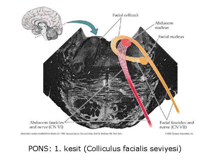 PONS: 1. kesit (Colliculus facialis seviyesi) 