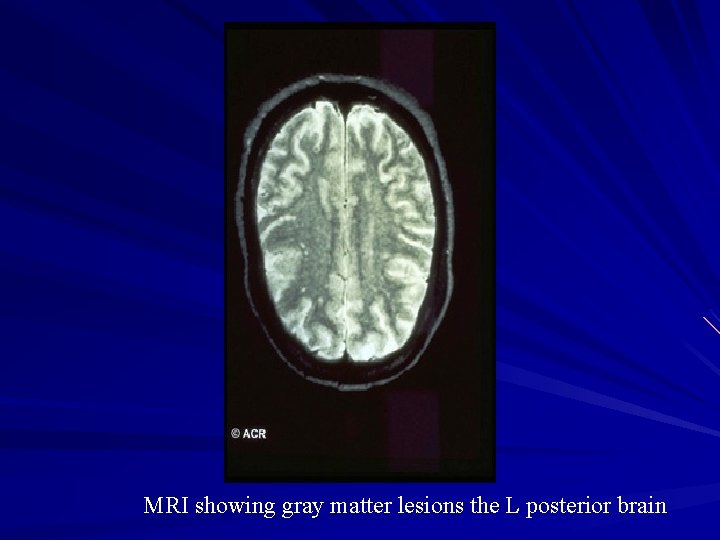 MRI showing gray matter lesions the L posterior brain 