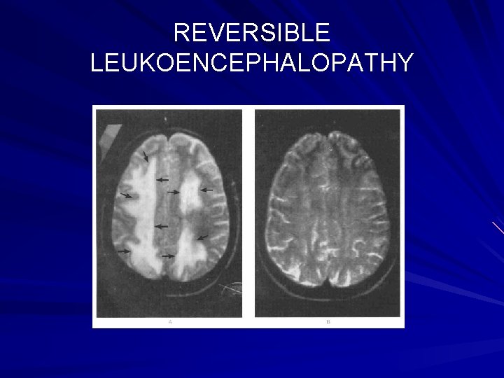 REVERSIBLE LEUKOENCEPHALOPATHY 