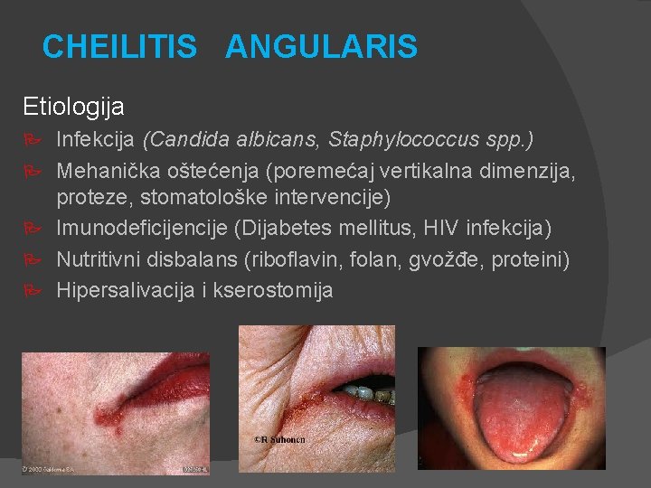 CHEILITIS ANGULARIS Etiologija P P P Infekcija (Candida albicans, Staphylococcus spp. ) Mehanička oštećenja