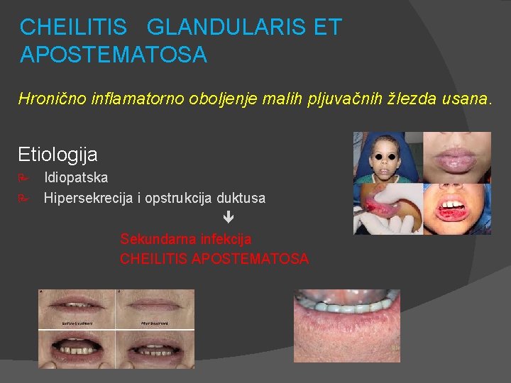 CHEILITIS GLANDULARIS ET APOSTEMATOSA Hronično inflamatorno oboljenje malih pljuvačnih žlezda usana. Etiologija Idiopatska P