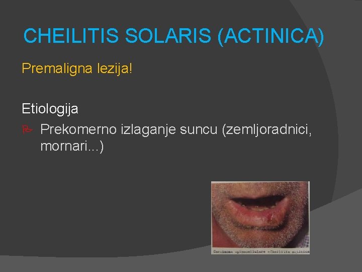 CHEILITIS SOLARIS (ACTINICA) Premaligna lezija! Etiologija P Prekomerno izlaganje suncu (zemljoradnici, mornari. . .